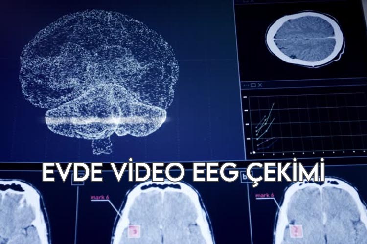 Evde Video EEG Çekimi
